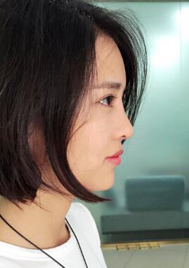 割雙眼皮+開眼角+隆鼻整形