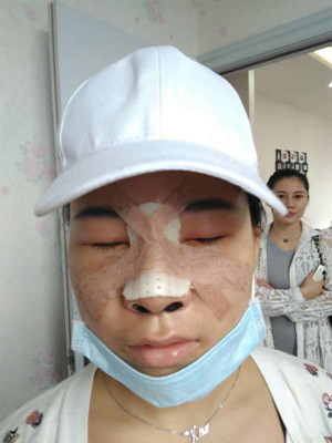 廣州廣美做的假體隆鼻，給大家分享一下手術(shù)前后過程以及對比照片