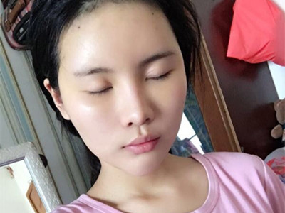 自體脂肪填充全臉，前后對比一下果棒棒噠!