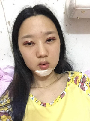 切開雙眼皮+假體隆下巴，我不再是典型的路人甲