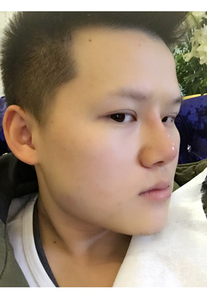 玻尿酸隆鼻+墊下巴親身經(jīng)歷~~果不錯(cuò)哦