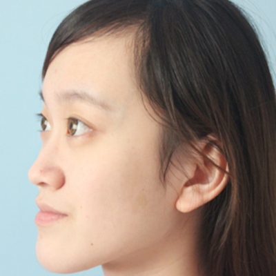 自體軟骨隆鼻手術(shù)前后對比果圖片分享，還有恢復過程哦~