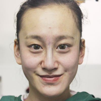 自體軟骨隆鼻手術(shù)前后對比果圖片分享，還有恢復過程哦~