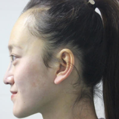 自體軟骨隆鼻手術(shù)前后對比果圖片分享，還有恢復過程哦~