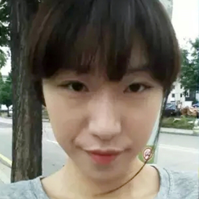 隆鼻整形+雙眼皮手術(shù)兩個月了，分享恢復(fù)前后對比果照片~