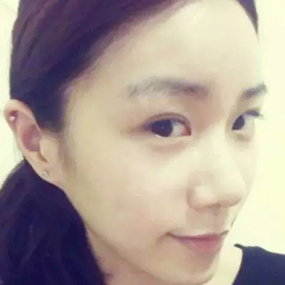 隆鼻整形+雙眼皮手術(shù)兩個月了，分享恢復(fù)前后對比果照片~