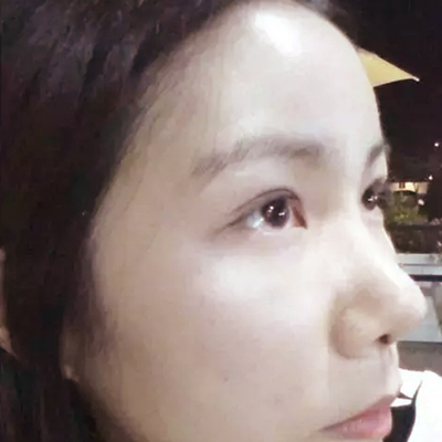 隆鼻整形+雙眼皮手術(shù)兩個月了，分享恢復(fù)前后對比果照片~