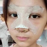 隆鼻整形恢復(fù)日記分享，整形價格8800元