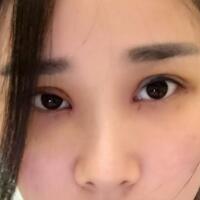 全切雙眼皮價格6800元，無神小眼變光彩大雙眼恢復(fù)過程分享