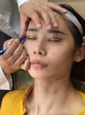 割雙眼皮術(shù)前設(shè)計圖