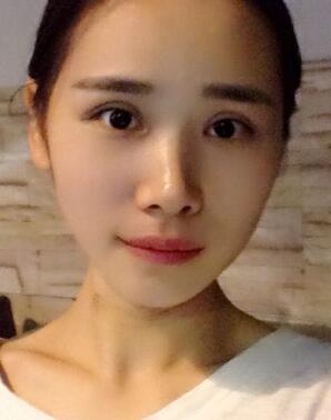 割雙眼皮恢復照片