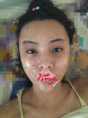 自體脂肪填充全臉，我也可以美美噠