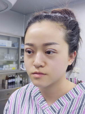 真人記錄了8周全切雙眼皮手術過程，還有對比照片喲