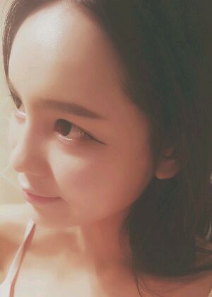 自體脂肪豐額頭+蘋果肌恢復(fù)兩個月照片分享