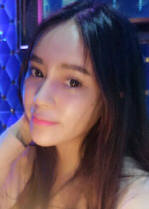 自體脂肪豐額頭+蘋果肌恢復(fù)兩個月照片分享