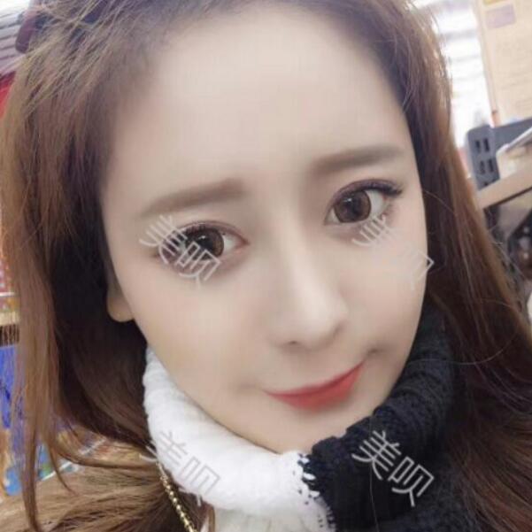 硅膠假體隆鼻+鼻翼縮小術(shù)后一個月恢復(fù)過程