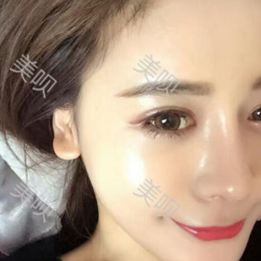 硅膠假體隆鼻+鼻翼縮小術(shù)后一個月恢復(fù)過程