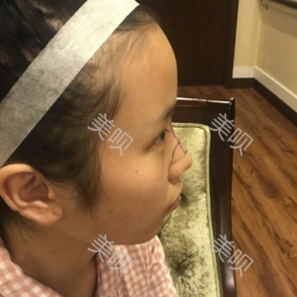 玻尿酸隆鼻前后對比照分享瞬間提升氣質(zhì)了哦