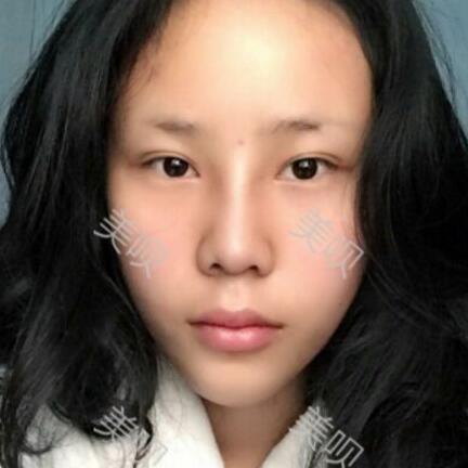 玻尿酸隆鼻前后對比照分享瞬間提升氣質(zhì)了哦