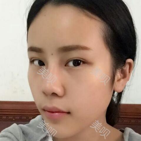 玻尿酸隆鼻前后對比照分享瞬間提升氣質(zhì)了哦