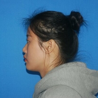 自體脂肪面部填充豐蘋果肌和太陽穴之后變年輕了不少哦