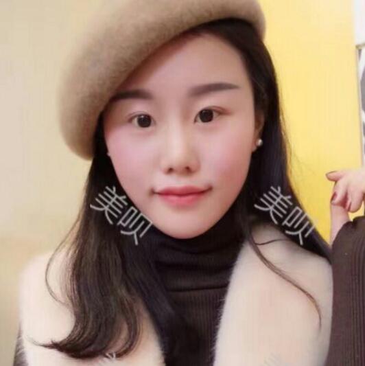 自體脂肪面部填充豐蘋果肌和太陽穴之后變年輕了不少哦