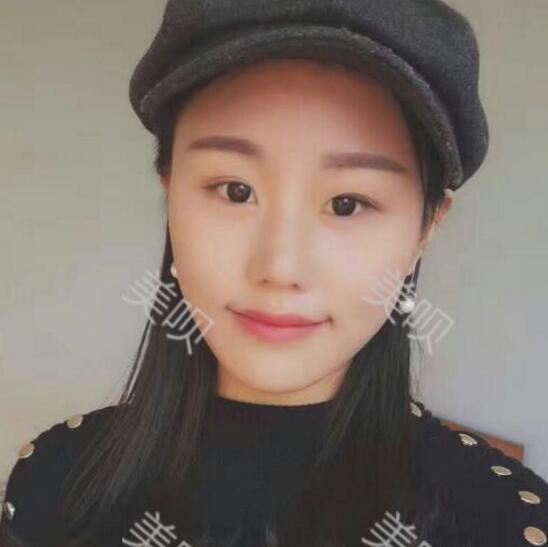 自體脂肪面部填充豐蘋果肌和太陽穴之后變年輕了不少哦