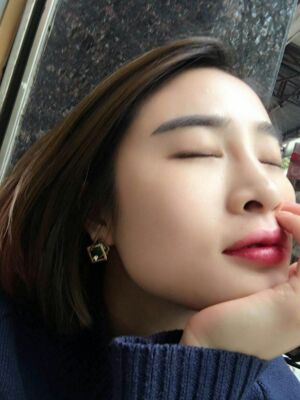 雙眼皮失敗修復(fù)之后疤痕完全沒(méi)有啦