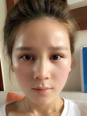 隆鼻和雙眼皮修復(fù)一起做的，現(xiàn)在氣質(zhì)提升好多