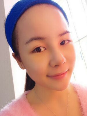 鼻部綜合整形真實案例，前后對比圖奉上