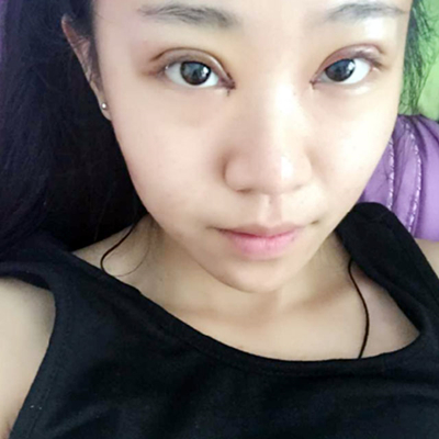 雙眼皮+開眼角術(shù)后三個(gè)月左右的果照片分享哦~