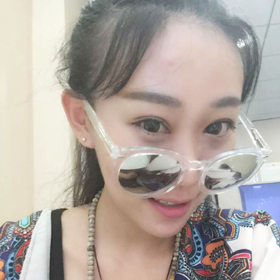 雙眼皮+開眼角術(shù)后三個(gè)月左右的果照片分享哦~