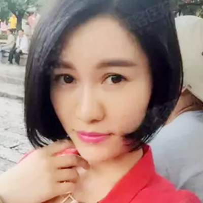 玻尿酸注射鼻子+下巴+太陽(yáng)穴+蘋果肌術(shù)后一個(gè)月的果照片~