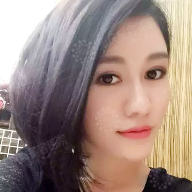 玻尿酸注射鼻子+下巴+太陽(yáng)穴+蘋果肌術(shù)后一個(gè)月的果照片~