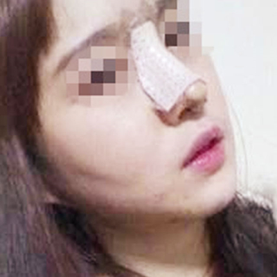 自體脂肪隆鼻術(shù)后一個月果分享，有前后對比照片喲~