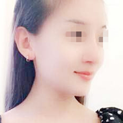 自體脂肪隆鼻術(shù)后一個月果分享，有前后對比照片喲~