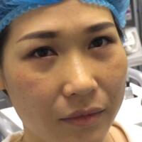 去眼袋手術(shù)多少錢？做了激光去眼袋價(jià)格5800元，恢復(fù)很好