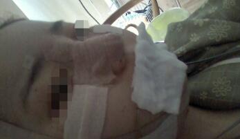 下頜骨整形手術(shù)當(dāng)天