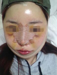 下頜骨整形第五天