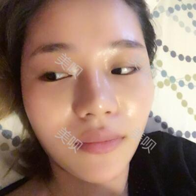 自體脂肪面部填充前后對比照的真實日記分享