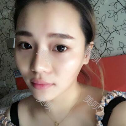 自體脂肪面部填充前后對比照的真實日記分享