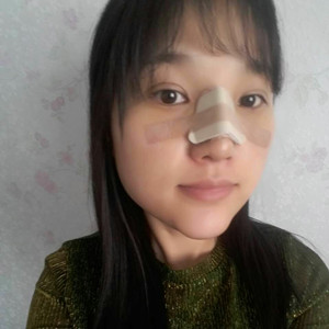 做了假體隆鼻+下巴，簡直是丑女大翻身啊