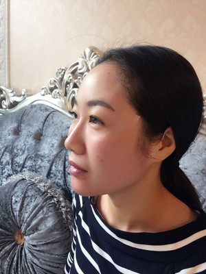 自體脂肪豐面頰，見證我蝶變的過程