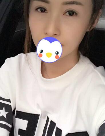 北京麗星雙眼皮修復(fù)半年了