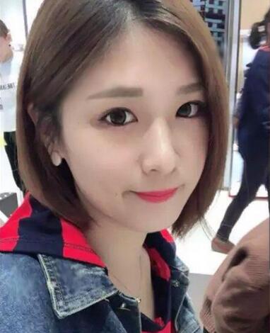 微創(chuàng)定點(diǎn)每天恢復(fù)過程圖 北京麗星雙眼皮3個(gè)月