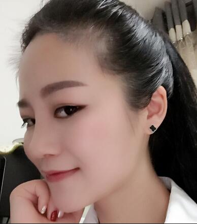 硅膠隆鼻前后對(duì)比 硅膠隆鼻+鼻小柱延長(zhǎng)恢復(fù)日記