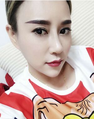 牛永敢做的隆鼻失敗修復(fù)，對比很明X哦~