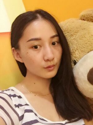 激光祛斑前后對比圖，雀斑全都沒啦