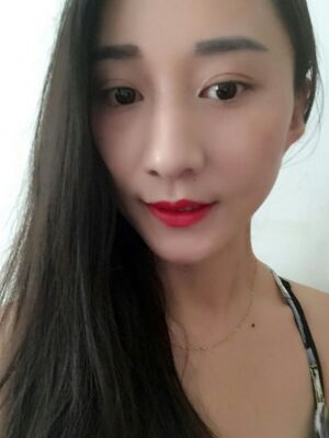 激光祛斑前后對比圖，雀斑全都沒啦