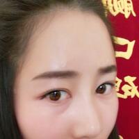 自體脂肪填充太陽(yáng)穴豐額頭親身經(jīng)歷，多過程恢復(fù)圖分享